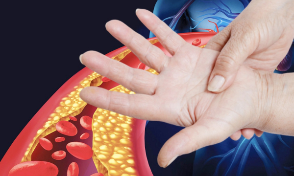 Признаком высокого холестерина назвали необычное поражение пальцев рук